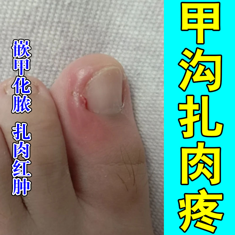 脚趾甲沟红肿疼脚大拇指嵌甲肉芽息肉扎肉草本膏乳舒缓疼痛
