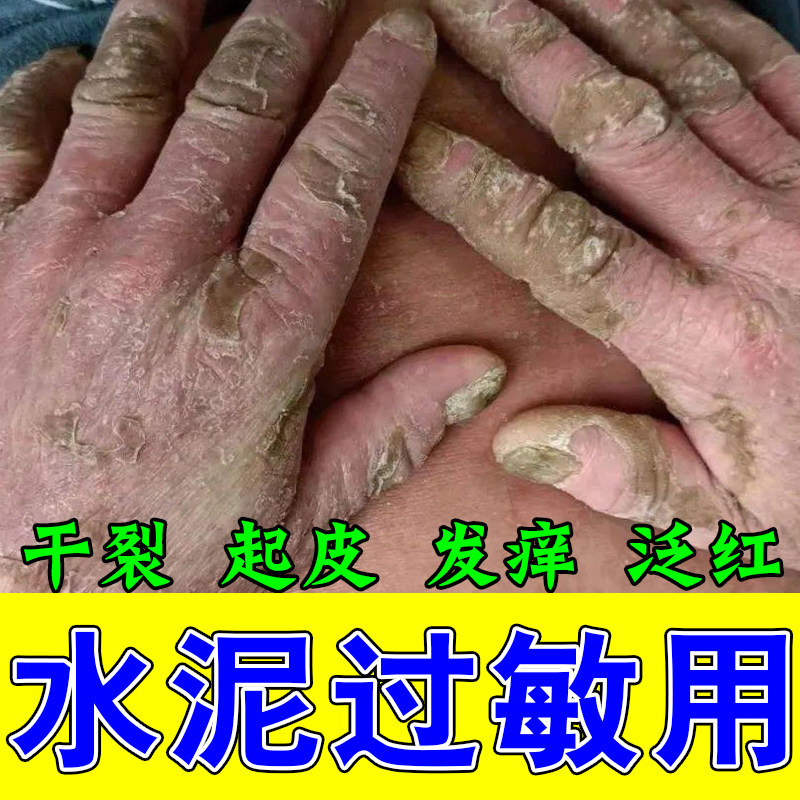 冶手背过敏痒水泥工地建筑手干裂粗糙起皮裂红肿草本修护舒缓膏乳