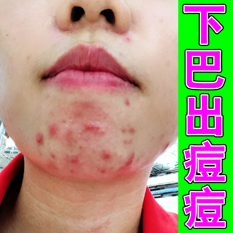 下巴出痘痘学生压力大脸部长痘痘熬夜上火痘内分泌失调闭口粉刺痘