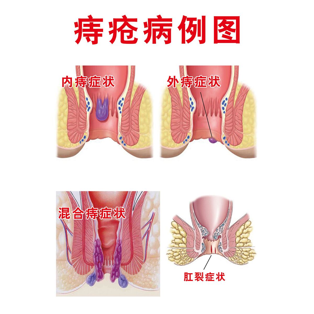 医院肛肠科知识宣传海报肛肠科痔疮病症图谱简介挂图肛门健康画
