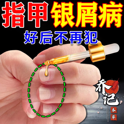 银屑病甲专用膏药好后不犯