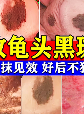 龟头去黑斑黑点黑色素沉淀男性龟头炎包皮垢真菌感染暗斑修复膏药