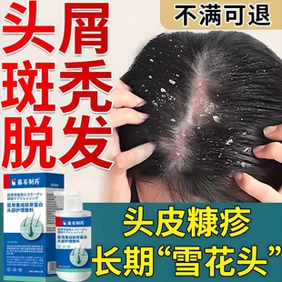 头皮糠疹专头皮屑块大结痂用脱发掉发斑秃头皮藓痒育发AH