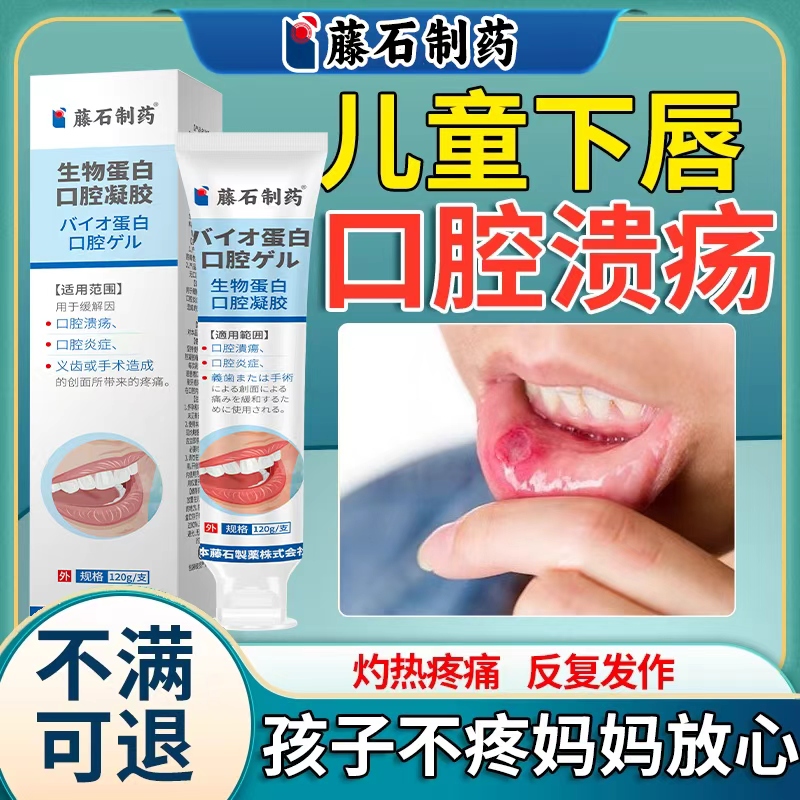 儿童下唇口腔溃疡灼热疼痛牙周炎口臭除火异味可搭喷雾凝胶AH
