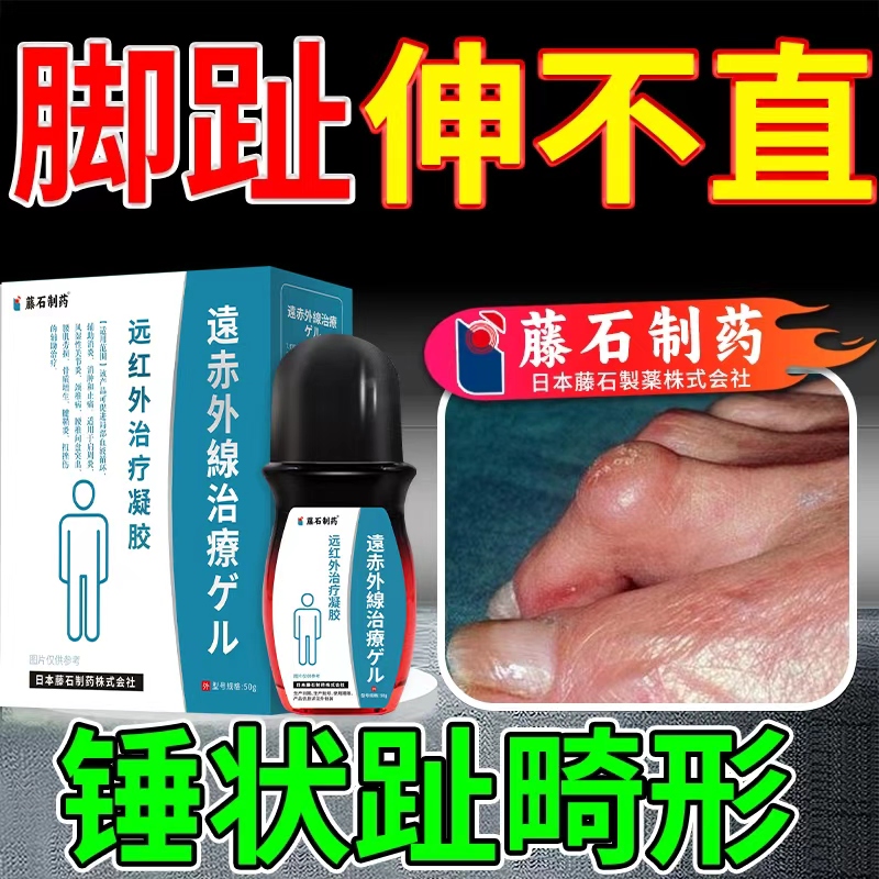 锤状趾手脚指弯曲关节变畸形伸不直挛缩肿大僵硬肌腱断裂膏AH