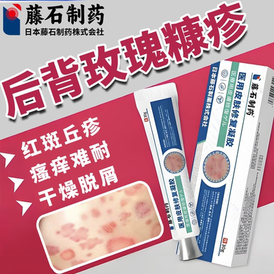 玫瑰糠疹止痒舒缓专用凝胶