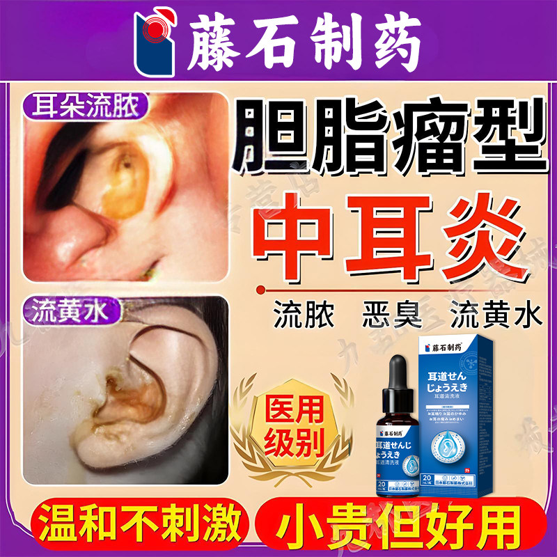 胆脂瘤型中耳炎滴耳液耳朵流黄脓黄水耳朵闷堵耳鸣慢性化脓性AH