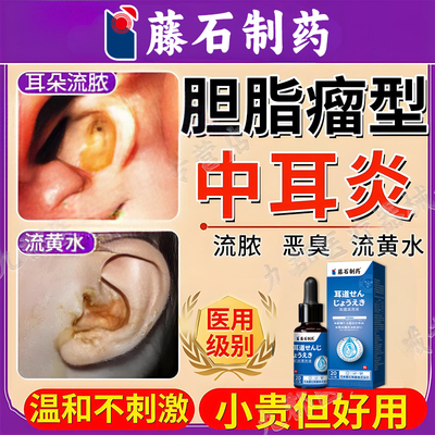 胆脂瘤型中耳炎滴耳液耳朵流黄脓黄水耳朵闷堵耳鸣慢性化脓性AH