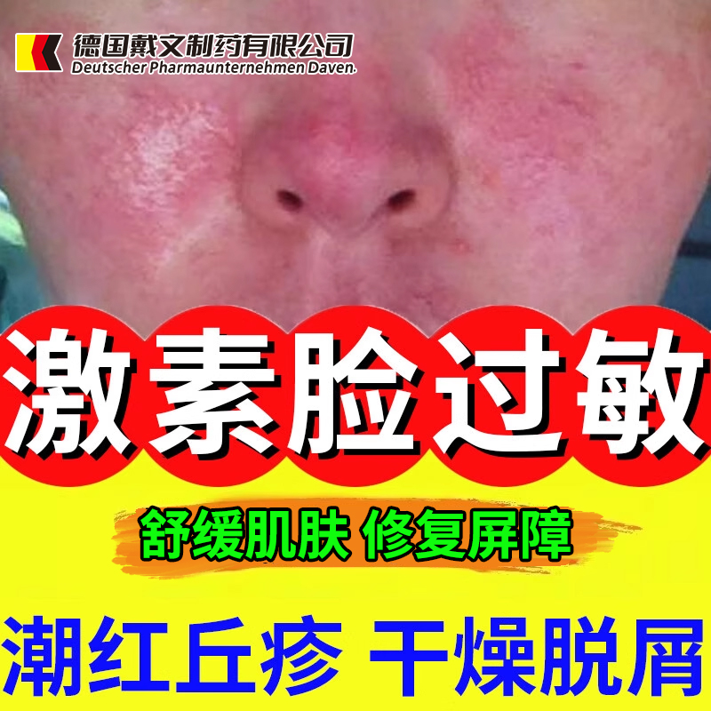 激素脸过敏感肌潮红丘疹干燥脱屑