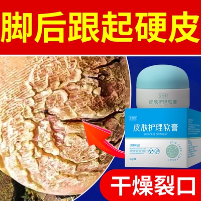 脚后跟干裂起硬皮角质化裂口手足皲裂疼真菌感染软化去死皮软膏YK