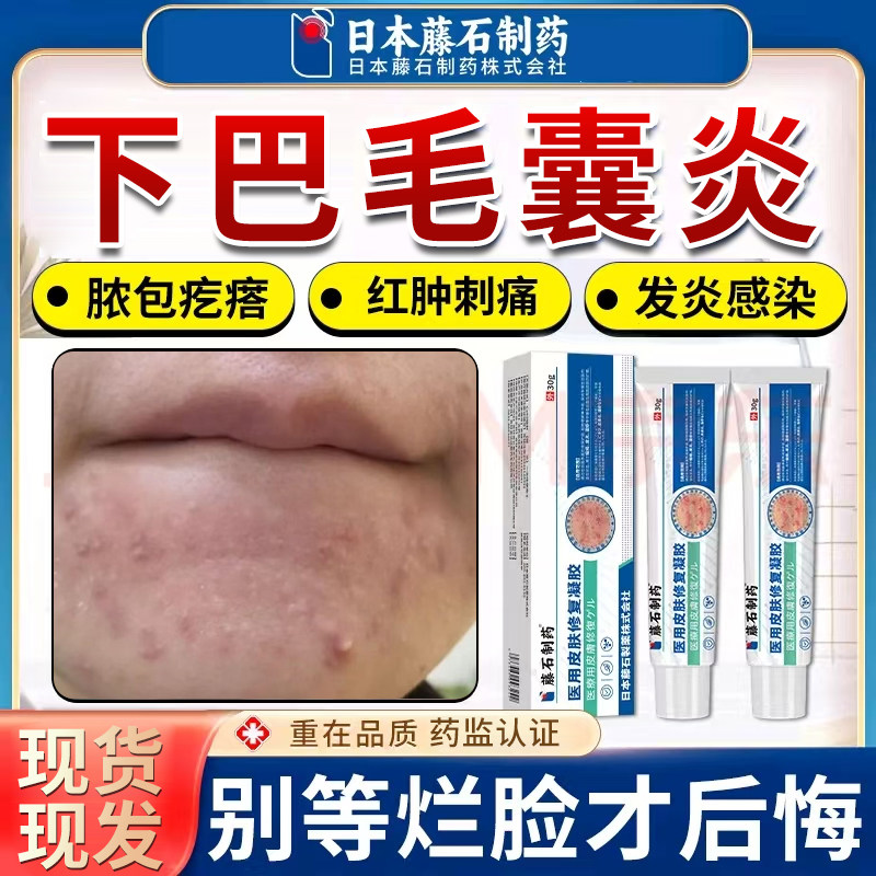 下巴毛囊炎额头脸部痘痘小硬疙瘩脓包红肿刺痛发炎感染胡须凝胶YK