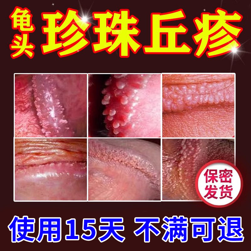 珍珠丘疹炎症龟头炎专用阴茎包皮红点瘙痒男性冠状沟珍珠粒去除y