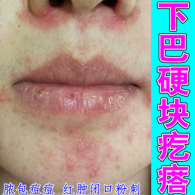 下巴硬块疙瘩额头痘脸上反复长痘去闭口粉刺硬块痘痘专用修复保湿
