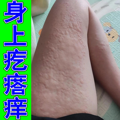 身上疙瘩痒皮肤痒掉屑起风团长红点红斑老年人小腿痒长痘专用草本