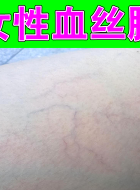 女性血丝腿脚上青筋凸起酸胀痛经常久坐久站毛细血管扩张草本修护