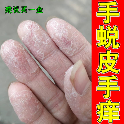 手蜕皮手痒手上起小水泡手干燥粗糙痒掉屑红肿干裂口外用修护药乳