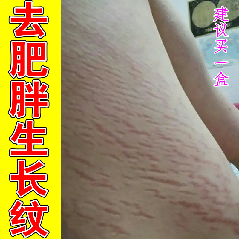 去肥胖生长纹腰腹上红纹妊娠纹青春期皮肤过度拉扯肚子肥胖纹修护