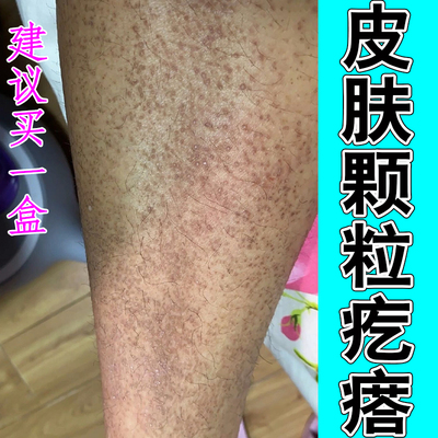 皮肤颗粒疙瘩顽固褐色斑点小腿痒改善身上黑色素沉淀斑点疙瘩修复