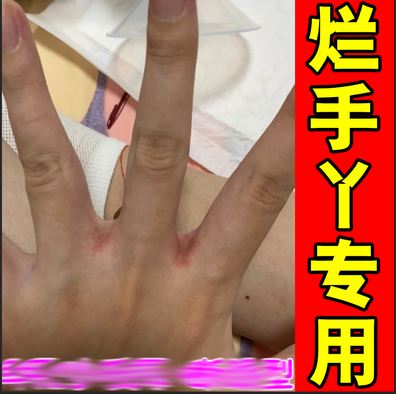 烂手丫专用手指缝溃烂药/真菌感染手气手上长水泡湿烂痒