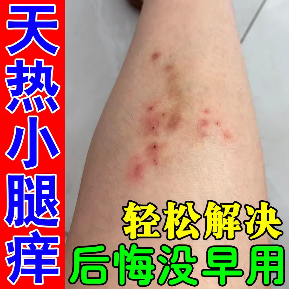 夏季天气热小腿皮肤干燥痒起红疙瘩腿部过敏身上长红点疹子专用膏
