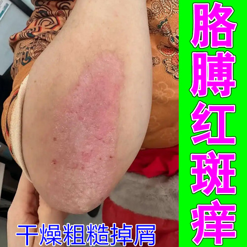 胳膊红斑痒身上起红疙瘩长小红点圆斑掉屑专用修复专冶皮肤痒的药