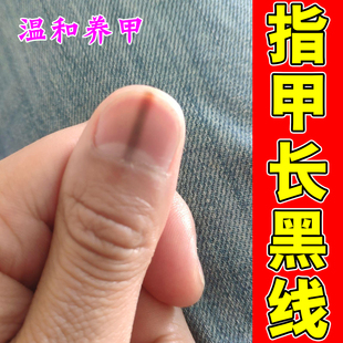 指甲有黑线手脚趾甲长竖纹营养不良挤压外伤甲下出血感染甲脆脱落
