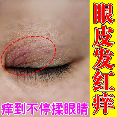 眼皮痒眼睛周围眼角痒红肿爆皮干燥有碎屑消除眼周过敏专用修复膏