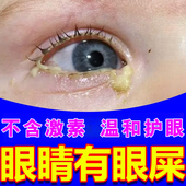 眼屎多眼药水治疗眼睛红血丝分泌物多粘稠干涩流泪去除眼屎滴眼液