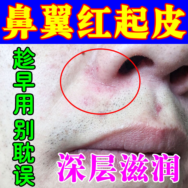 鼻子两侧发红痒脱皮脂溢性皮炎鼻翼两边泛红干燥起皮红痒痘痘痤疮