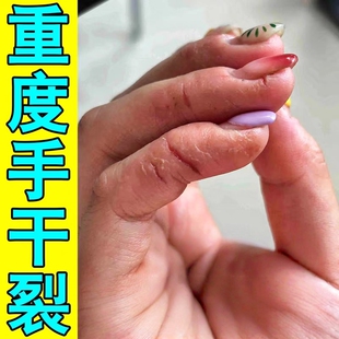 手裂口子干裂修复霜治手指开裂起皮角化型脱皮真菌感染手脚皲裂药