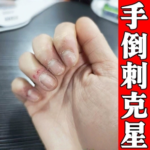 手指长倒刺营养油防手上起倒刺肉刺去指甲边缘脱死皮干裂修复神器