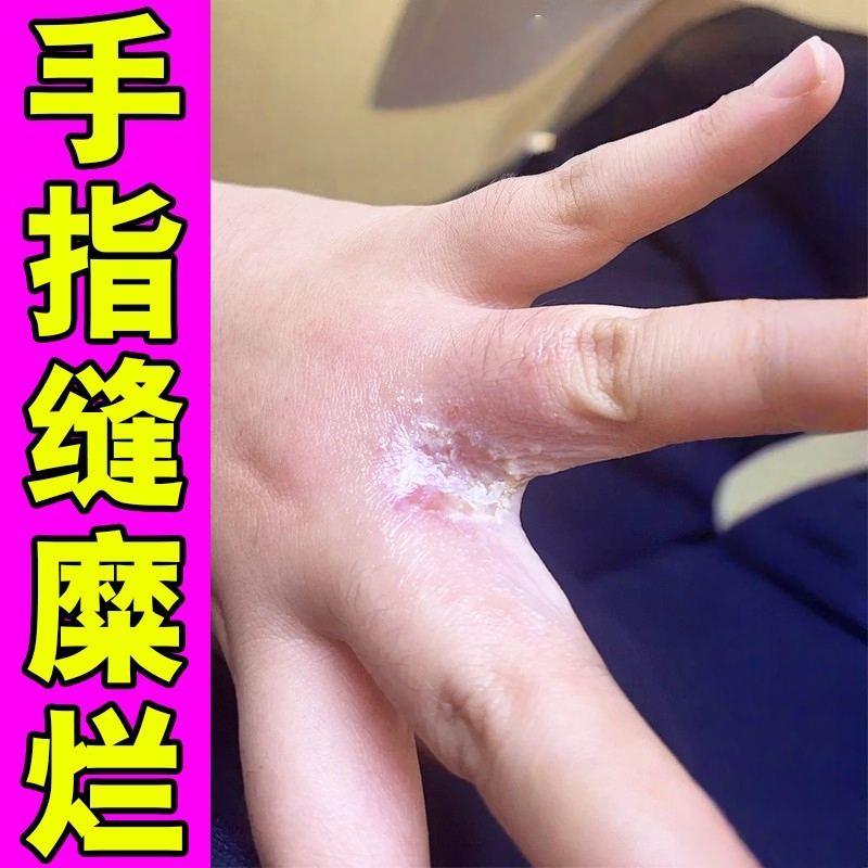 手指缝溃烂痒烂手丫专用膏药指间糜烂感染湿疹开裂流脓发痒外用膏