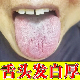 舌头裂纹有齿痕舌苔发白厚腻溃烂灼痛脾胃健口臭调理地图舌除异味