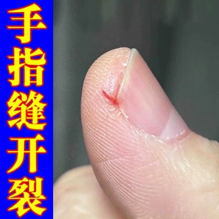 秋冬天指甲缝开裂愈合膏药治手指头裂口子干裂脱皮疼防皲裂修复霜