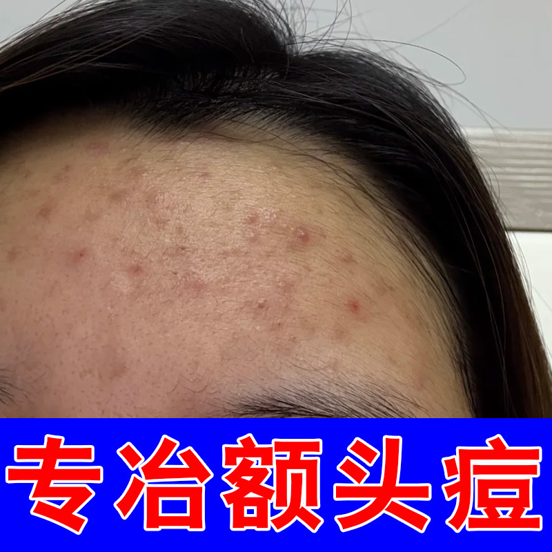 额头长痘痘红肿疙瘩闭口马拉色菌皮肤消毒护理（消）