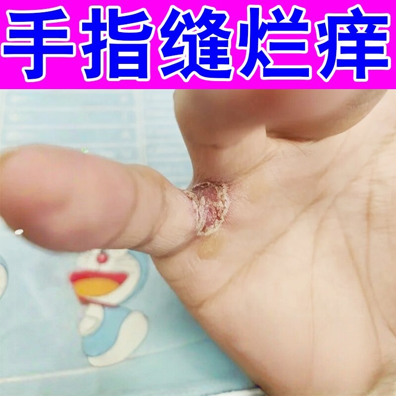 手指缝溃烂痒烂手丫专用膏药皮肤干燥发痒脱皮开裂指间烂疼手痒膏