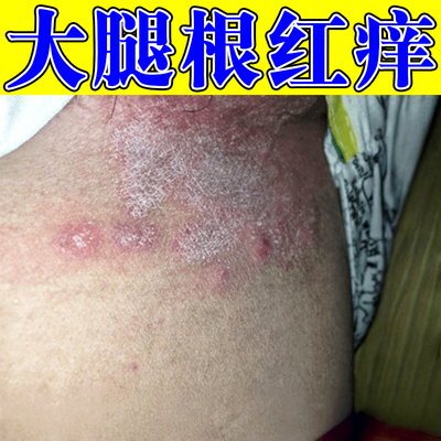 大腿内侧皮肤发痒真菌感染大腿根部潮湿发红起皮长红斑红疹特药效