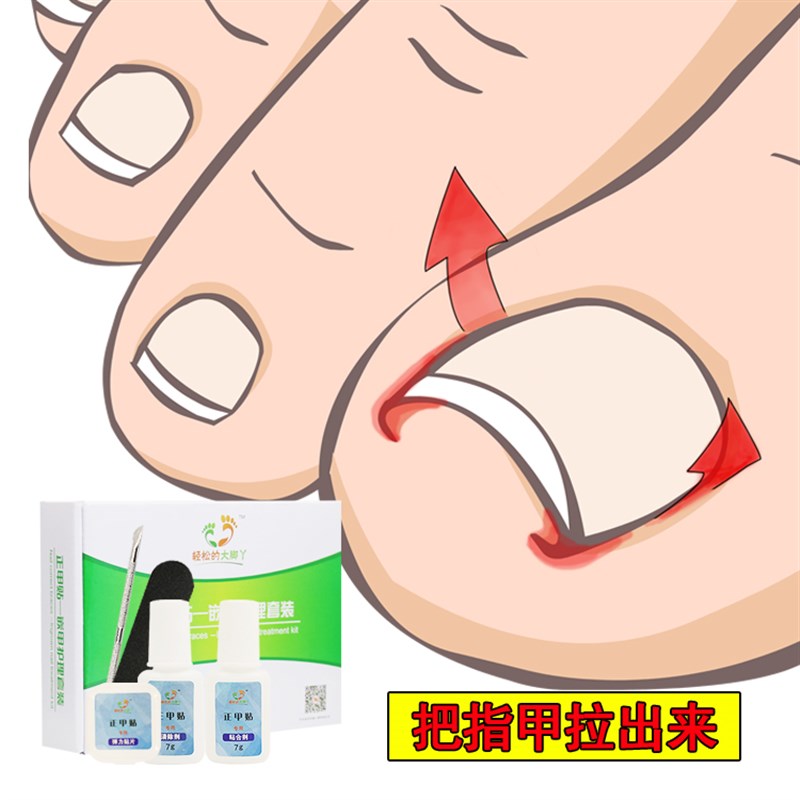 正甲贴套装嵌甲i贴脚趾甲嵌甲矫正器纠正炎甲沟神器修指甲拉拉贴