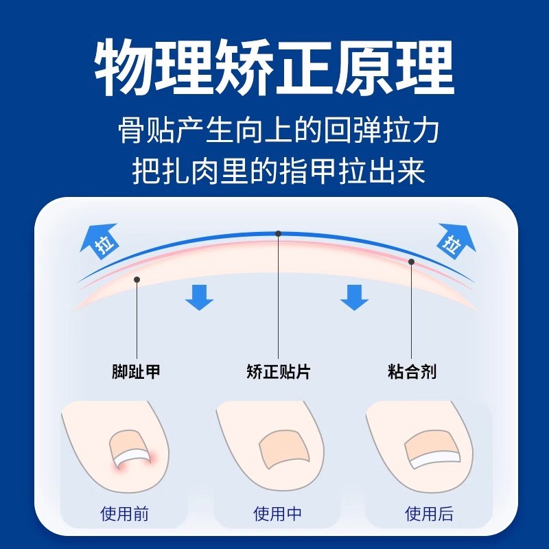 正甲贴片钛合金弹甲沟嵌矫正器脚D趾甲盖内嵌神器专用指甲长肉里