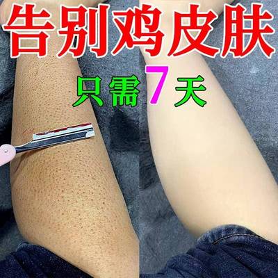 鸡皮肤疙瘩毛囊角化儿童沐浴露祛脖子去除角质药膏遮瑕维e尿素霜