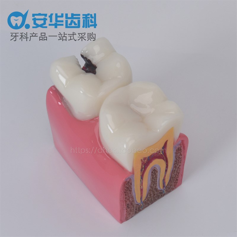 牙齿模型6倍龋齿对比模型 蛀牙演示模H型剖面模型医患沟通教学模