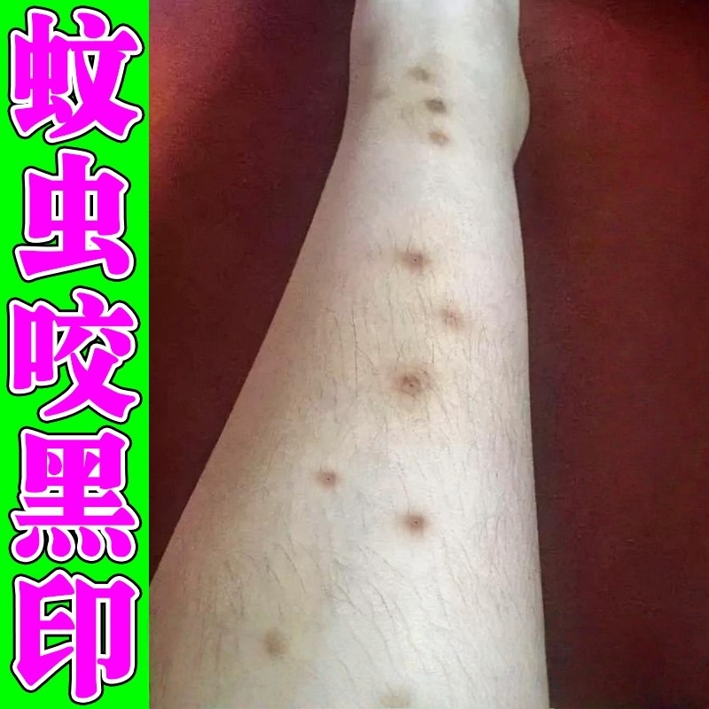 夏天蚊子叮咬去黑印淡化腿上黑色素沉淀修复腿挠印痘豆印疤痕膏