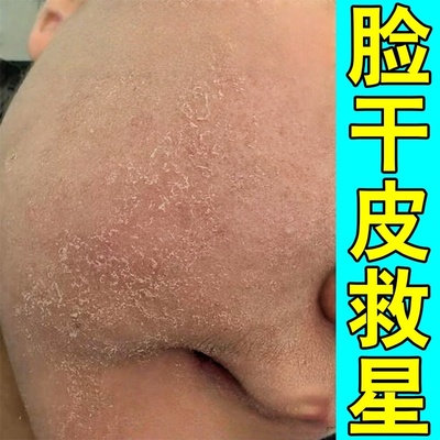 脸干燥起皮嘴角有碎屑泛红脱皮修复霜皮肤干燥痒下巴起癣过敏甘油