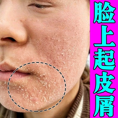 脸起皮干燥有碎屑修复霜男女皮肤干燥红痒嘴角下巴起皮过敏脱皮乳