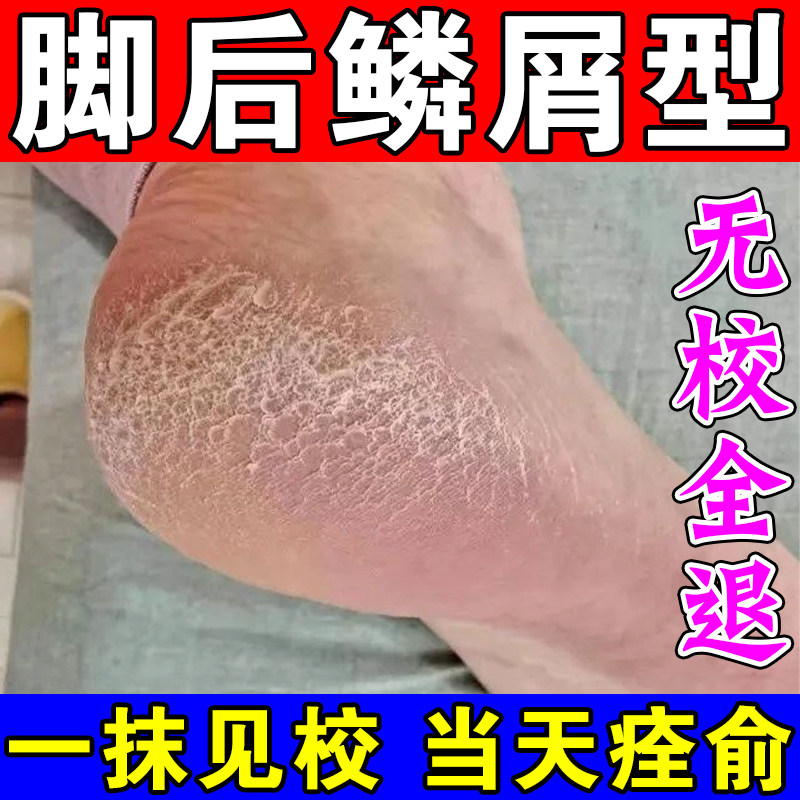 脚后跟干裂真菌感染鳞屑角化型脚气脱皮起硬皮去死皮足癣痒修复霜