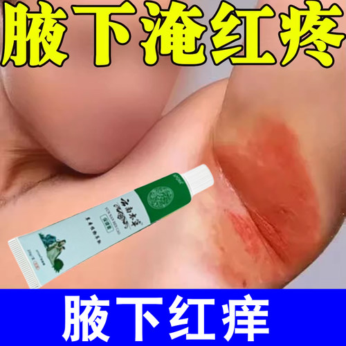 腋下淹红胳肢窝出汗刺挠红肿疼痛长痘痘潮湿有异味腋窝红痒外用膏