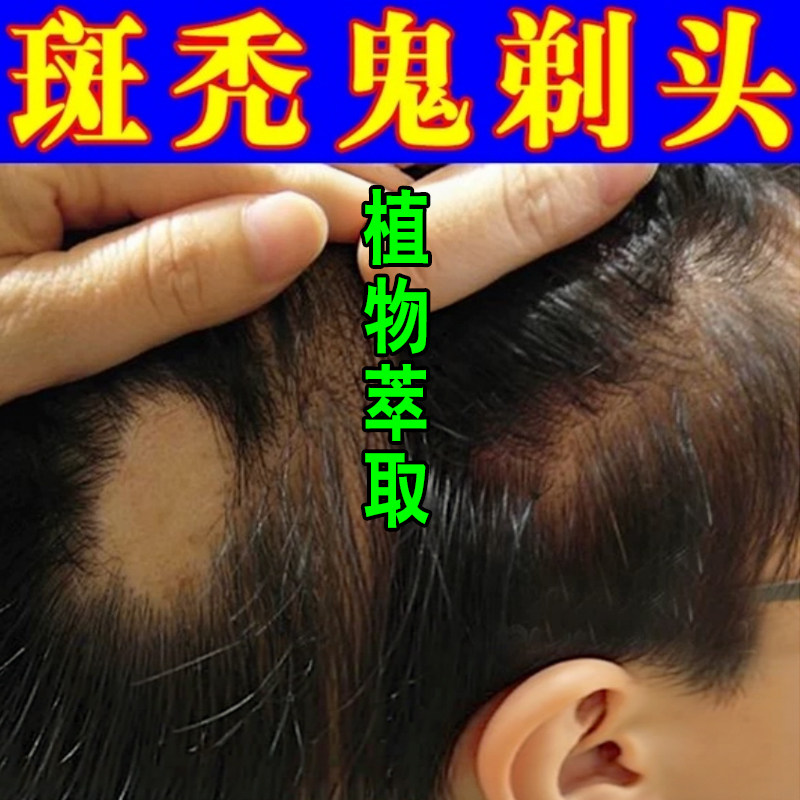 斑秃头皮养护鬼剃头块状掉发硬币皮肤消毒护理（消）