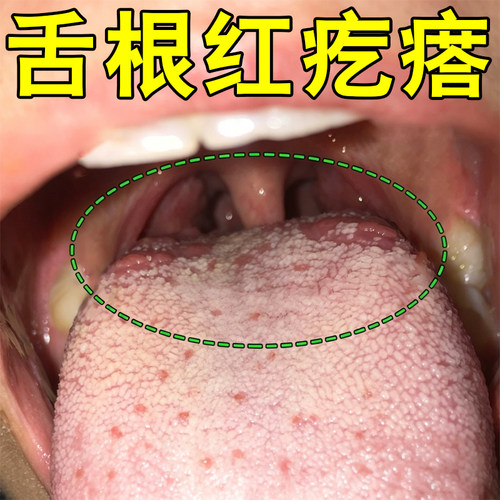 舌根红疙瘩两侧凸起小肉球红点疙瘩滤泡舌苔白厚腻舌裂纹专用喷剂