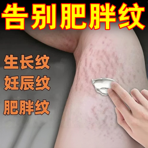 去肥胖纹生长纹修复霜消大腿学生腰腹上肥胖纹除男女通用药软膏