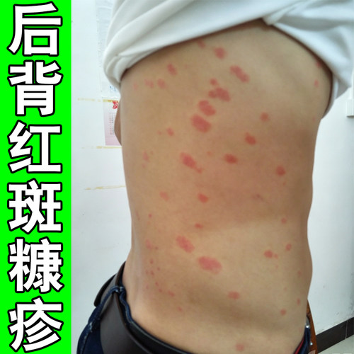 后背长圆形红斑免疫力低下玫瑰糠疹感染身上皮肤痒外用修复软膏